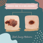 Graphic of melanoma